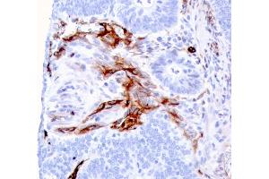 Formalin-fixed, paraffin-embedded human Colon Carcinoma stained with Nestin Mouse Monoclonal Antibody (NES/2911). (Nestin Antikörper  (AA 698-844))