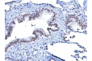 IHC-P Image Rad54 antibody [C3], C-term detects Rad54 protein at nucleus on human lung carcinoma by immunohistochemical analysis. (ATRX Antikörper  (C-Term))