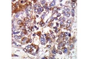 IHC analysis of FFPE human hepatocarcinoma stained with the cGKI beta antibody (PRKG1 Antikörper  (AA 629-660))