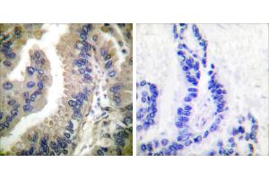 Peptide - +Immunohistochemical analysis of paraffin-embedded human lung carcinoma tissue using HSP90 cyto antibody (#C0234). (HSP90AA1 Antikörper)