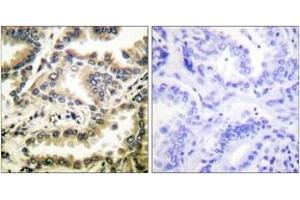Immunohistochemistry analysis of paraffin-embedded human lung carcinoma tissue, using NF-kappaB p65 (Acetyl-Lys310) Antibody. (NF-kB p65 Antikörper  (acLys310))