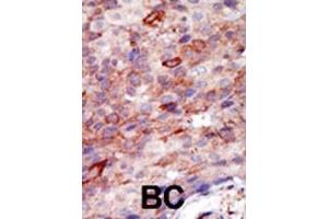 Formalin-fixed and paraffin-embedded human cancer tissue reacted with the primary antibody, which was peroxidase-conjugated to the secondary antibody, followed by DAB staining. (YWHAB Antikörper  (N-Term))