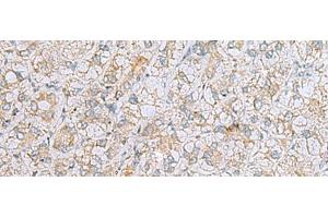 Immunohistochemistry of paraffin-embedded Human liver cancer tissue using LRRC49 Polyclonal Antibody at dilution of 1:40(x200) (LRRC49 Antikörper)