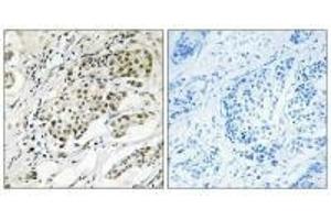 Immunohistochemistry analysis of paraffin-embedded human breast carcinoma tissue using CDYL2 antibody. (CDYL2 Antikörper  (N-Term))