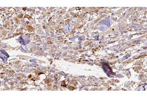 ABIN6277073 at 1/100 staining Human Melanoma tissue by IHC-P. (IL1RN Antikörper  (Internal Region))