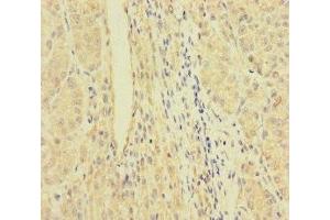 Immunohistochemistry of paraffin-embedded human liver cancer using ABIN7167064 at dilution of 1:100 (RFTN2 Antikörper  (AA 1-300))