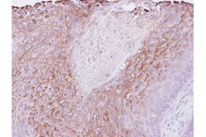 IHC-P Image Immunohistochemical analysis of paraffin-embedded Cal27 xenograft , using PIGR, antibody at 1:500 dilution. (PIGR Antikörper)