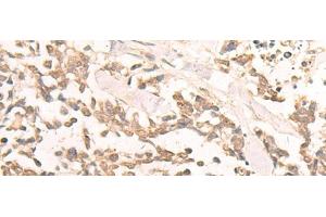 Immunohistochemistry of paraffin-embedded Human lung cancer tissue using EN2 Polyclonal Antibody at dilution of 1:30(x200) (EN2 Antikörper)