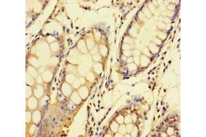 Immunohistochemistry of paraffin-embedded human colon cancer using ABIN7148417 at dilution of 1:100 (NDUFAF1 Antikörper  (AA 25-327))