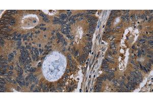 Immunohistochemistry of paraffin-embedded Human colon cancer tissue using TSC22D3 Polyclonal Antibody at dilution 1:40 (TSC22D3 Antikörper)