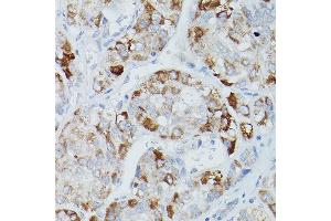 Immunohistochemistry of paraffin-embedded human liver cancer using Alkaline Phosphatase (ALPL) Rabbit pAb (ABIN3021385, ABIN3021386, ABIN1512569 and ABIN6214987) at dilution of 1:50 (40x lens). (ALPL Antikörper  (AA 20-270))