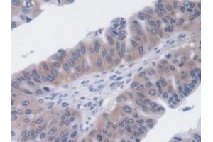 Detection of UCP2 in Human Liver cancer Tissue using Monoclonal Antibody to Mitochondrial Uncoupling Protein 2 (UCP2) (UCP2 Antikörper  (AA 154-289))