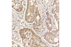 Immunohistochemistry of paraffin-embedded human lung cancer using ERp19 Rabbit mAb (ABIN7270799) at dilution of 1:200 (40x lens).