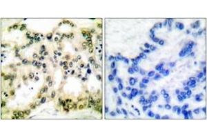 Immunohistochemistry analysis of paraffin-embedded human lung carcinoma, using Cyclin B1 (Phospho-Ser126) Antibody.