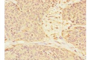 Immunohistochemistry of paraffin-embedded human ovarian cancer using ABIN7167139 at dilution of 1:100 (RASSF6 Antikörper  (AA 1-303))