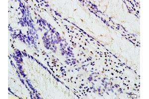 Formalin-fixed and paraffin embedded human colon carcinoma labeled with Anti-TBL1X Polyclonal Antibody, Unconjugated at 1:200 followed by conjugation to the secondary antibody and DAB staining