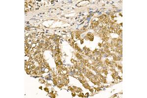 Immunohistochemistry of paraffin-embedded human liver cancer using [KO Validated] RA Rabbit pAb (ABIN3021646, ABIN3021647, ABIN3021648 and ABIN1513457) at dilution of 1:100 (40x lens). (RAB5 Antikörper  (AA 1-215))