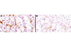 Immunohistochemistry (IHC) image for anti-Mesothelin (MSLN) (Extracellular Domain) antibody (ABIN400817) (Mesothelin Antikörper  (Extracellular Domain))