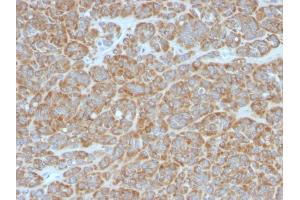 Formalin-fixed, paraffin-embedded human Melanoma stained with Bcl-2 Mouse Monoclonal Antibody (BCL2/796). (Bcl-2 Antikörper)