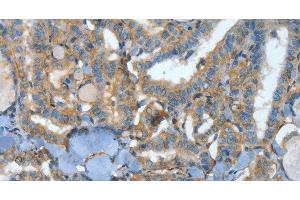 Immunohistochemistry of paraffin-embedded Human thyroid cancer tissue using ATP4B Polyclonal Antibody at dilution 1:40