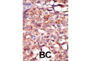 Formalin-fixed and paraffin-embedded human cancer tissue reacted with RIPK4 polyclonal antibody  , which was peroxidase-conjugated to the secondary antibody, followed by AEC staining. (RIPK4 Antikörper  (C-Term))