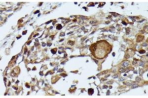Immunohistochemistry of paraffin-embedded Human esophageal cancer using MAP3K3 Polyclonal Antibody at dilution of 1:100 (40x lens). (MAP3K3 Antikörper)