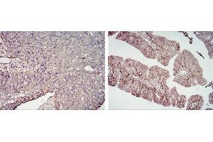 Immunohistochemical analysis of paraffin-embedded cervical cancer tissues (left) and ovarian cancer tissues (right) using CD276 mouse mAb with DAB staining. (CD276 Antikörper)
