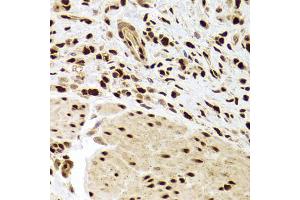 Immunohistochemistry of paraffin-embedded human gastric cancer using ANP32A Antibody (ABIN5973390) at dilution of 1/100 (40x lens).