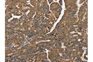 The image on the left is immunohistochemistry of paraffin-embedded Human cervical cancer tissue using ABIN7192064(PTPN20A/PTPN20B Antibody) at dilution 1/40, on the right is treated with synthetic peptide. (PTPN2 Antikörper)