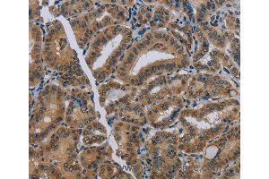 Immunohistochemistry of Human thyroid cancer using NAT10 Polyclonal Antibody at dilution of 1:40 (NAT10 Antikörper)