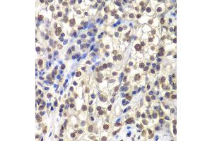 Immunohistochemistry of paraffin-embedded human kidney cancer using CENPC antibody at dilution of 1:200 (400x lens). (CENPC1 Antikörper)