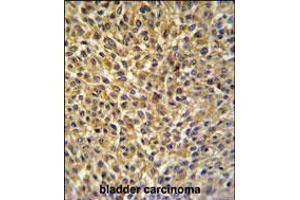 CRIP1 Antibody IHC analysis in formalin fixed and paraffin embedded bladder carcinoma followed by peroxidase conjugation of the secondary antibody and DAB staining. (CRIP1 Antikörper  (C-Term))
