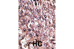 Formalin-fixed and paraffin-embedded human hepatocellular carcinoma tissue reacted with MAGEC1 polyclonal antibody  , which was peroxidase-conjugated to the secondary antibody, followed by AEC staining. (MAGEC1 Antikörper  (C-Term))