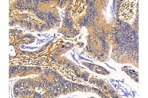 ABIN7093127 and ABIN7098695 at 1/100 staining Human colorectal cancer by IHC-P. (Clca3 Antikörper)