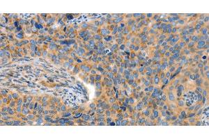 Immunohistochemistry of paraffin-embedded Human cervical cancer tissue using ADAMTS18 Polyclonal Antibody at dilution 1:30