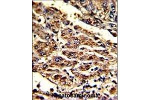 Formalin-fixed and paraffin-embedded human hepatocarcinoma with HOMER1 Antibody (N-term), which was peroxidase-conjugated to the secondary antibody, followed by DAB staining. (HOMER1 Antikörper  (N-Term))