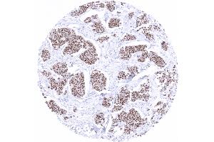 Breast Breast cancer of no special type NST showing moderate to strong GATA3 immunostaining (GATA3 Antikörper)