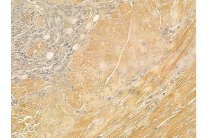 ABIN6260540 and ABIN6276944 at 1/100 staining human tongue carcinoma by IHC-P. (CCL21 Antikörper  (C-Term))
