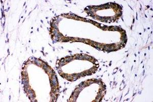 IHC-P: Dicer antibody testing of human breast cancer tissue (DICER1 Antikörper  (AA 1-195))