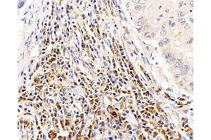 Immunohistochemistry analysis of paraffin-embedded human lung cancer using CASP1 Polyclonal Antibody at dilution of 1:300. (Caspase 1 Antikörper)