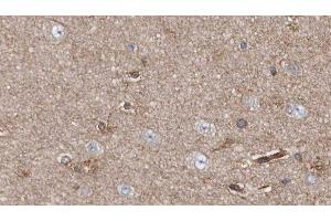 ABIN6279117 at 1/100 staining Human brain cancer tissue by IHC-P. (APBA2 Antikörper  (Internal Region))