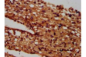 IHC image of ABIN7145527 diluted at 1:600 and staining in paraffin-embedded human melanoma performed on a Leica BondTM system. (SGCB Antikörper  (AA 124-219))