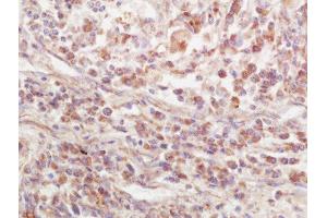 Formalin-fixed and paraffin embedded human lung carcinoma labeled with Rabbit Anti-EPS15R Polyclonal Antibody, Unconjugated  at 1:200 followed by conjugation to the secondary antibody and DAB staining (EPS15L1 Antikörper  (AA 275-380))