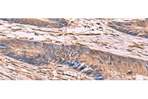 Immunohistochemistry of paraffin-embedded Human colorectal cancer tissue using KCNN2 Polyclonal Antibody at dilution of 1:65(x200) (KCNN2 Antikörper)