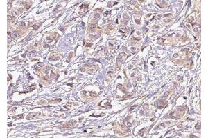 ABIN6275240 at 1/100 staining Human breast cancer tissue by IHC-P. (SLC25A21 Antikörper  (Internal Region))