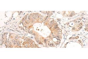 Immunohistochemistry of paraffin-embedded Human colorectal cancer tissue using HTRA1 Polyclonal Antibody at dilution of 1:55(x200) (HTRA1 Antikörper)