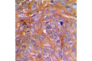 Immunohistochemical analysis of Caspase 8 (pS347) staining in human breast cancer formalin fixed paraffin embedded tissue section. (Caspase 8 Antikörper  (pSer347))