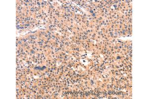 Immunohistochemistry of Human thyroid cancer using APBA2 Polyclonal Antibody at dilution of 1:80