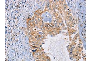The image on the left is immunohistochemistry of paraffin-embedded Human cervical cancer tissue using ABIN7192619(SPAG6 Antibody) at dilution 1/30, on the right is treated with synthetic peptide. (SPAG6 Antikörper)
