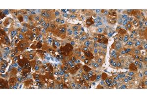 Immunohistochemistry of paraffin-embedded Human liver cancer using ARMCX2 Polyclonal Antibody at dilution of 1:40 (ARMCX2 Antikörper)